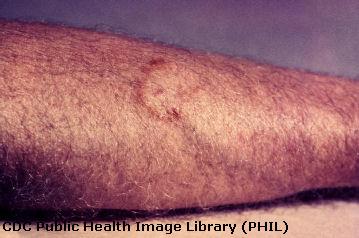Ringworm on arm