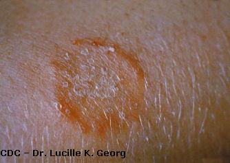 Close-up of ringworm patch