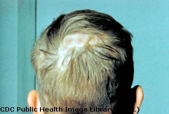 Ringworm on scalp