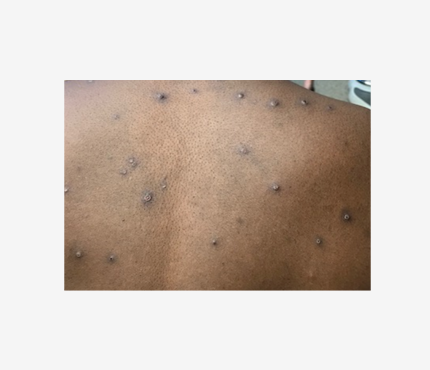 Photo of Monkey Pox rash