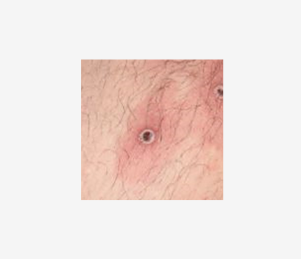 Photo of Monkey Pox rash