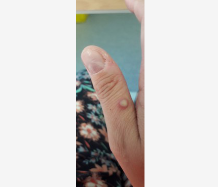 Photo of Monkey Pox rash