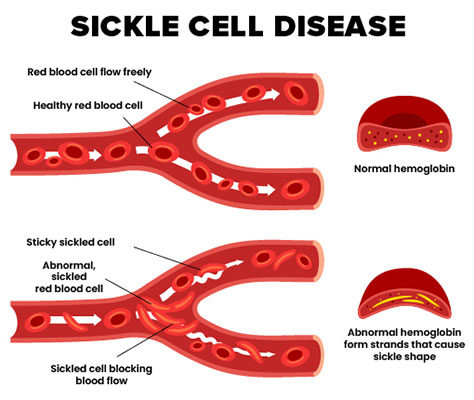 Sickled red blood cells can block the flow of blood and cause pain crises, or other complications. Blocked blood vessels stop the regular flow of oxygen throughout the body