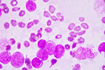 cancer photo
