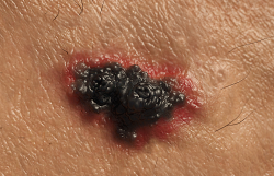 Melanoma