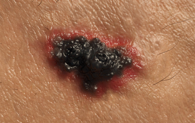 melanoma