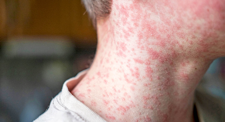 Measles Information