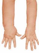 Picture of swollen arm
