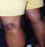 Example of Eyrtheman Migrans Rash - Picture 4